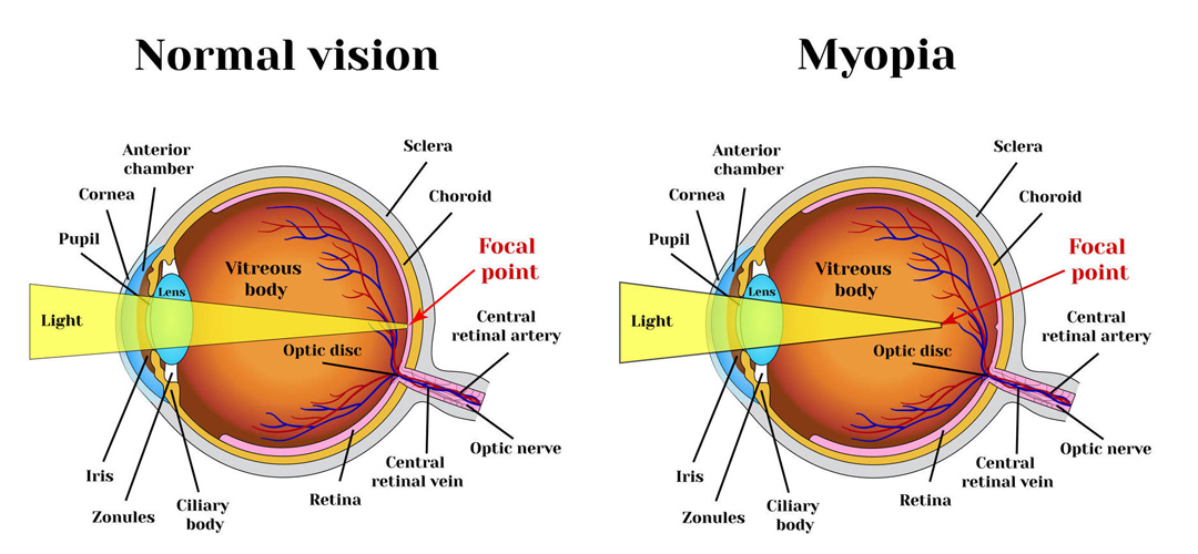 Ce este miopia? – Simptomele miopiei