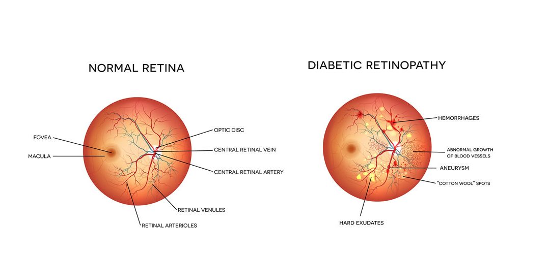 diabeti dhe sëmundjet e retinës
